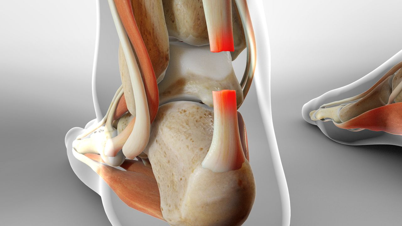 Preventing Complications: Key Considerations in Achilles Tendon Rupture ...
